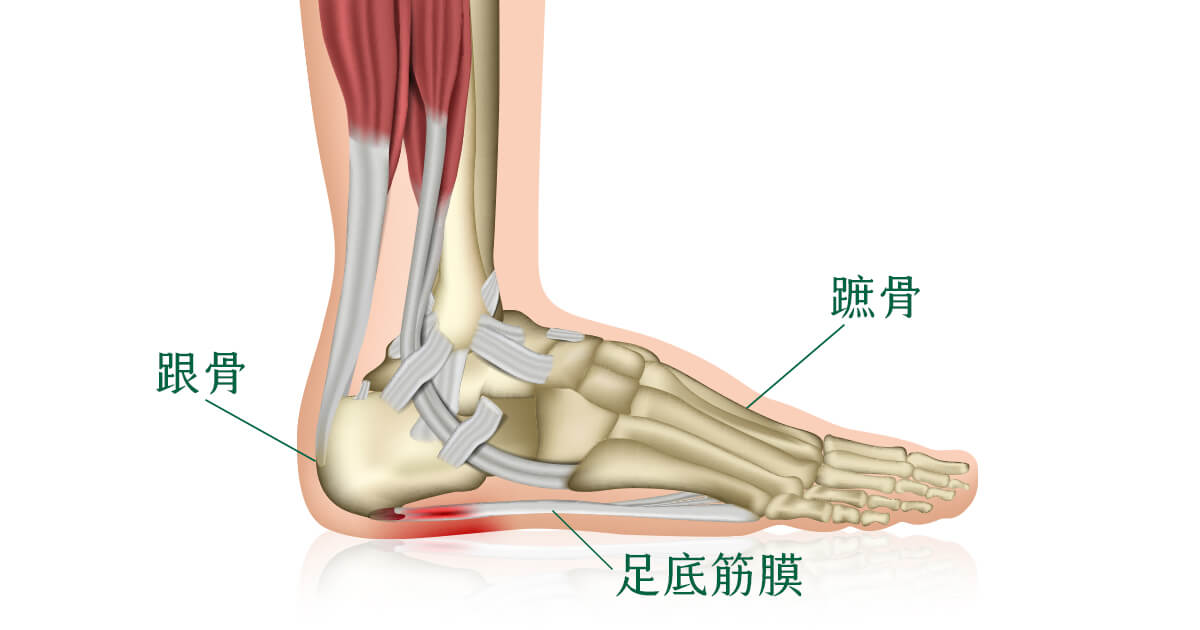 足部結構看足底筋膜炎