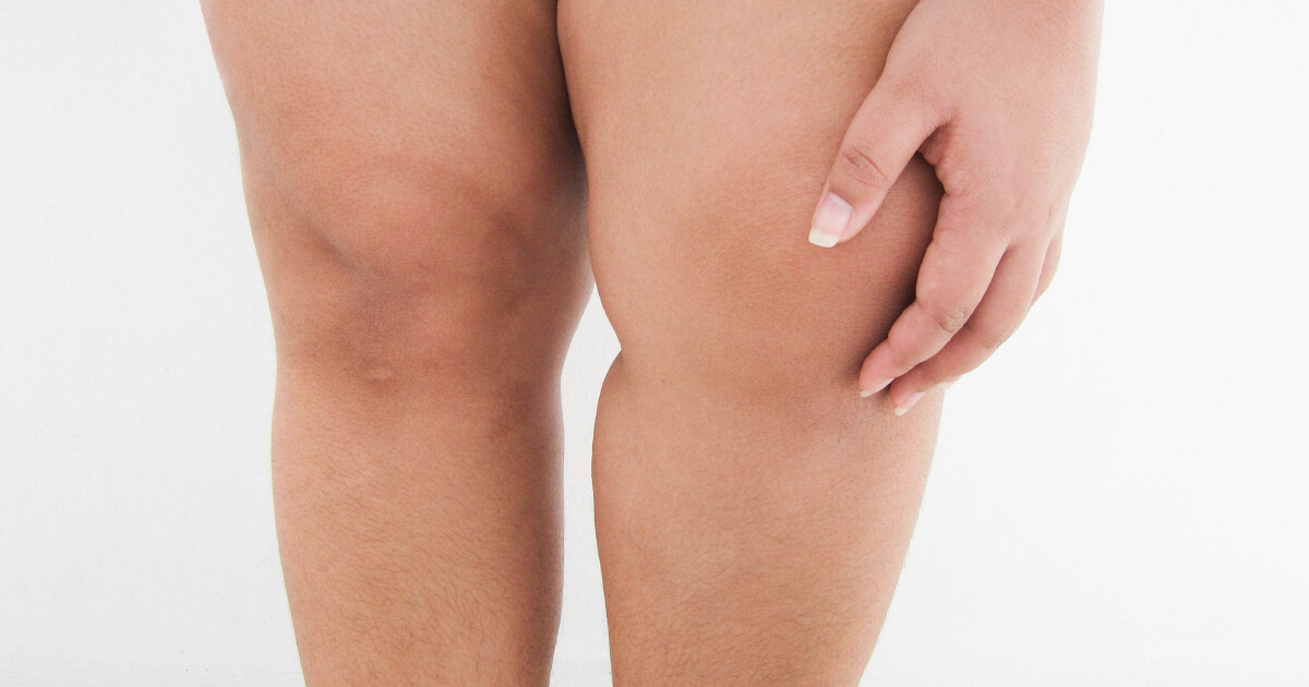 膝關節痛症狀：腫脹、疼痛、發熱、酸痛無力